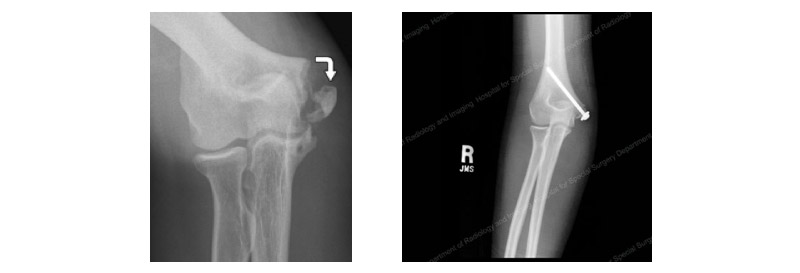 elbow-x-rays