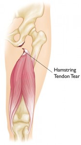 Hamstring Tear Image