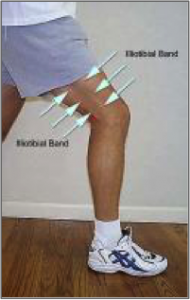 Iliotibial band noted prominently along the lateral thigh.Lateral hip stabilizers.